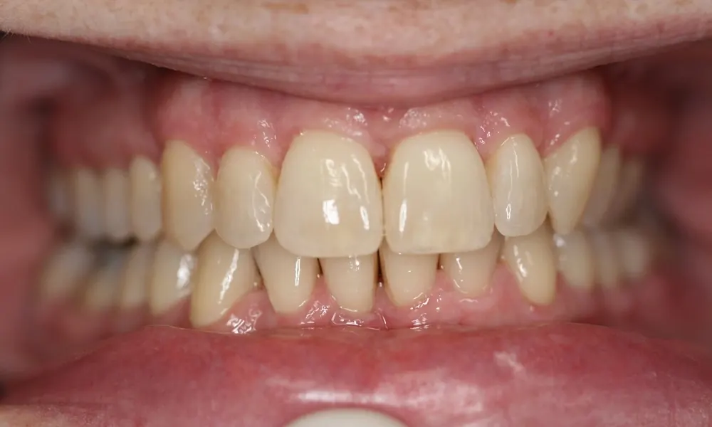 After: the same smile with the front teeth evenly aligned.