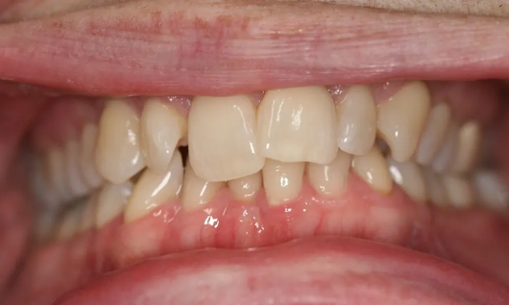 Before: crowded, overlapping upper front teeth.